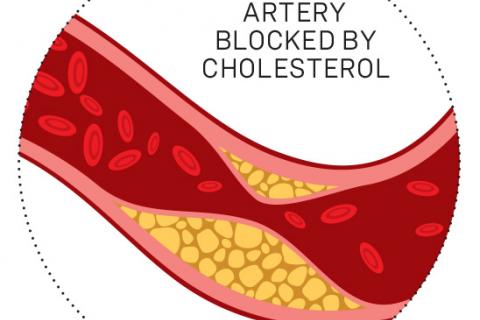 Artery blocked by cholesterol